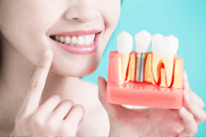 03-dental-implants