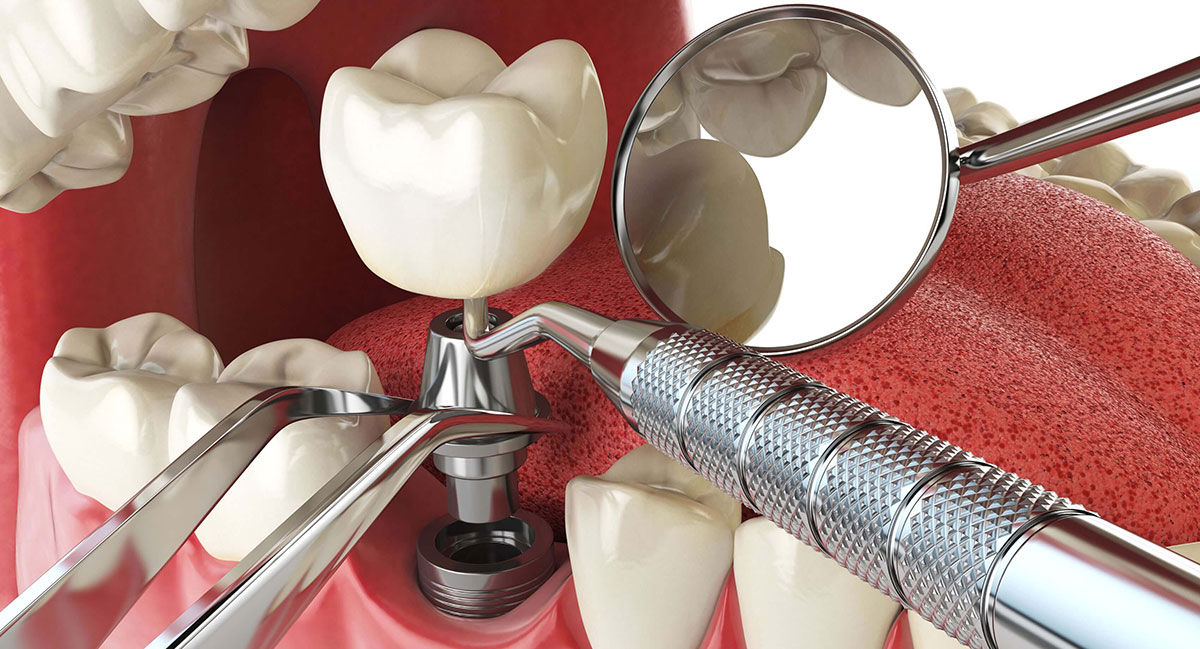 Implant dentar la Clinica Dr. Carmen Popa: soluția modernă pentru un zâmbet complet